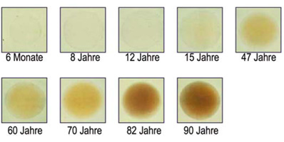 Einf&auml;rbung Linse Alter