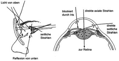 Streulichter Blendung