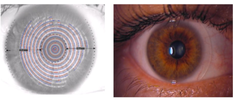 Dezentrierte Pupillenlagen