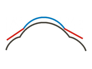 Optikzone Kontaktlinse zu klein
