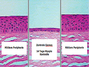 Orthokeratologie Epithelzellen