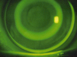 Orthokeratologie Fluobild