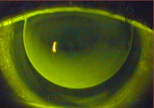 dezentrierte Kontaktlinse