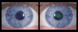 Monovision