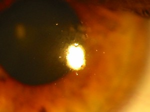 Kontaktlinsen Lipide