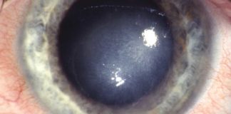 Wasserstoffperoxid und Kontaktlinsenpflege – verträglich und wirksam