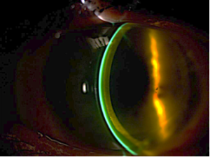 Darstellung der i-MATRIX Sklerallinse im optischen Schnitt