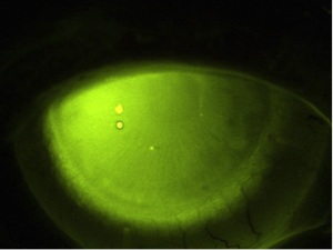 Darstellung der i-MATRIX Sklerallinse in der Fluoreszein-Übersichtsbetrachtung