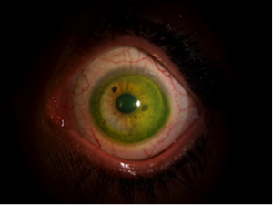 Darstellung der i-MATRIX Sklerallinse in der Weiss-Licht-Übersichtsbetrachtung