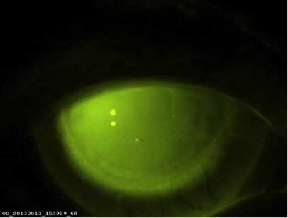 i-MATRIX Sklerallinse in der Fluoreszein-Gesamtübersicht