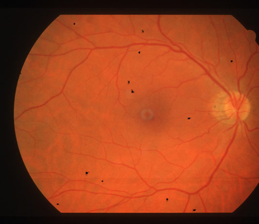 Optiker gewinnen mit revolutionärer Software Kunden RetinaLyze