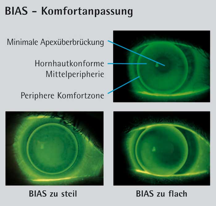 Die Grundidee der BIAS und BIAS-F ist das Prinzip der Komfortanpassung