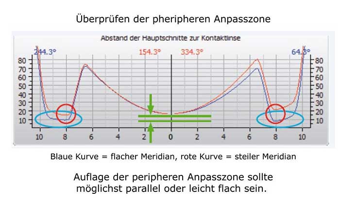 Die periphere Auflage sollte möglichst parallel oder leicht flach zur Hornhaut verlaufen