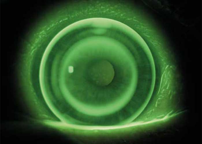 Fluoreszeinbild wöhlk OKE nach 3 Monaten bei Ausgangsrefraktion –3,00 dpt