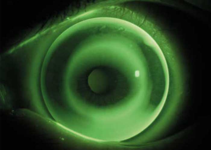 Fluoreszeinbild wöhlk OKE auf einer Hornhaut mit 3/10 mm Radiendifferenz