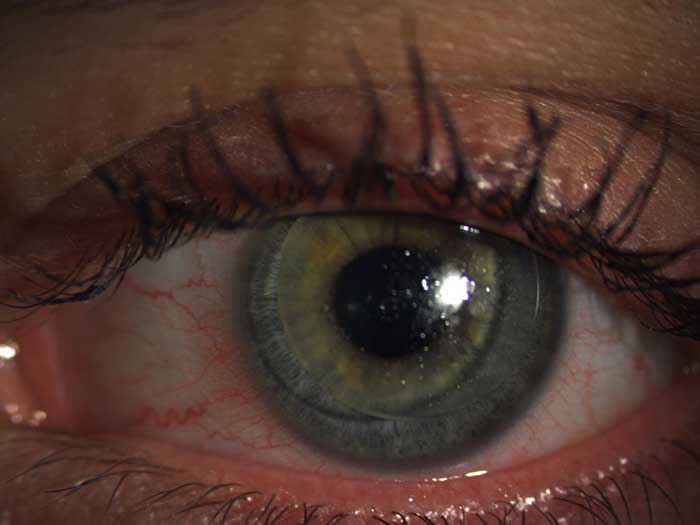 Abb 3: RGP Kontaktlinsen auf dem Auge der Kundin
