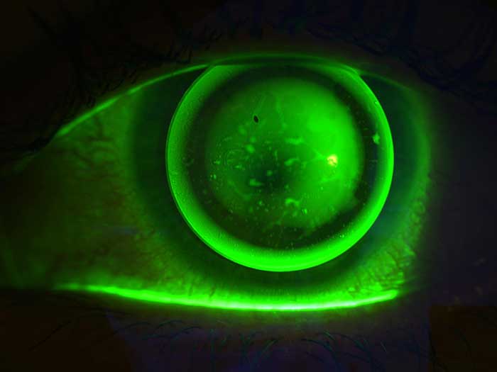 Abb 4: Fluo-Bild der RGP Kontaktlinse auf dem Auge der Kundin