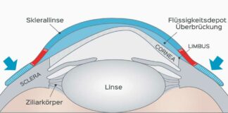 ScleraFlex von SwissLens – Ein Fallbericht