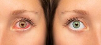 Trockene Augen – Beratung und Hilfe bei Optiker und Optometristen