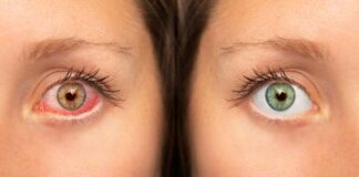 Trockene Augen – Beratung und Hilfe bei Optiker und Optometristen
