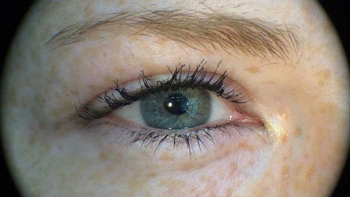 Rechtes Auge ohne Linse und linkes Auge ohne Kontaktlinse