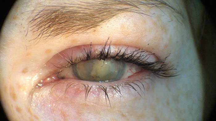 Rechtes Auge ohne Linse und linkes Auge ohne Kontaktlinse