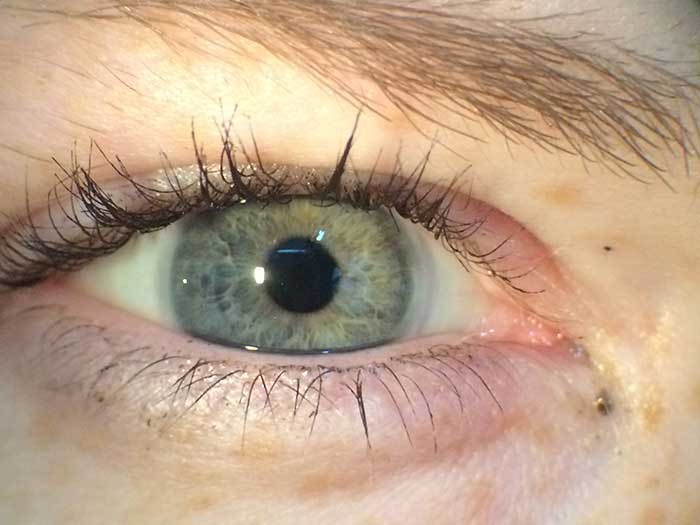 Rechtes Auge mit optischer Kontaktlinse und linkes Auge mit prosthetischer Iriskontaktlinse