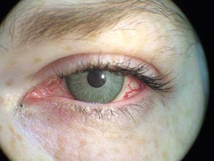 Rechtes Auge mit optischer Kontaktlinse und linkes Auge mit prosthetischer Iriskontaktlinse