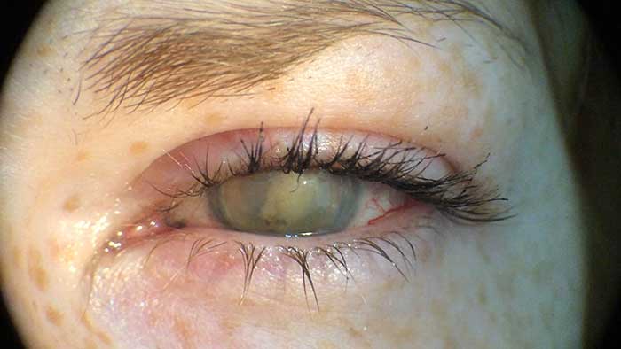 Auf Nachfrage besitzt sie zur Fernkorrektion weder Brille noch Kontaktlinsen. Zum Lesen benutzt sie eine selbstgewählte Fertiglesebrille in den Stärken +2,50dpt.