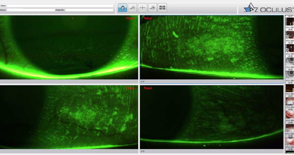 Abbildung 4: Darstellung der Epitheldefekte rechtes und linkes Auge am Keratograph 5M mit JENVIS Pro Dry Eye Report