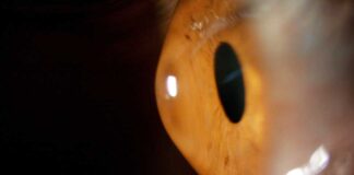 Keratokonus und weiche Kontaktlinsen