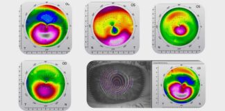 Medisoft K – Neue Möglichkeit in der Versorgung bei irregulären Hornhäuten