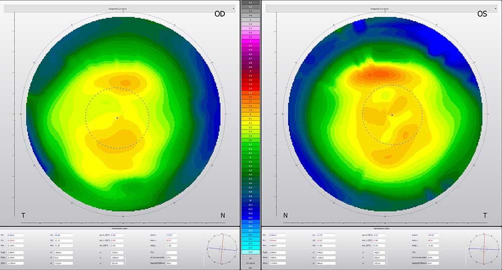 Abb. 5: Fall 4, 46 Jahre: beginnende Presbyopie, verkleinerte Optikzone