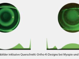 Hyperopie als spannende Erweiterung der Ortho-K-Versorgung