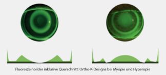 Hyperopie als spannende Erweiterung der Ortho-K-Versorgung Hyperopie als spannende Erweiterung der Ortho-K-Versorgung