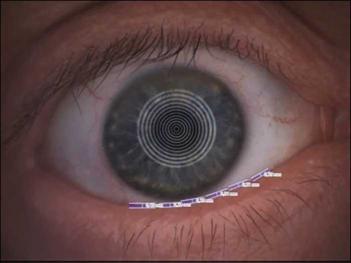 Fortgeschrittene Tränenfilmanalyse mit Weißlicht (Tearscope)
